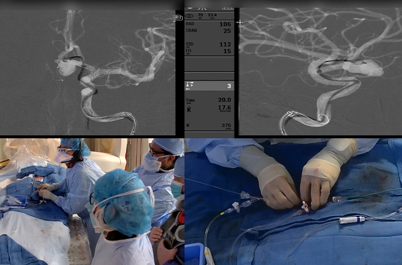 Memorial Neuroscience Institute first live streamed brain aneurysm