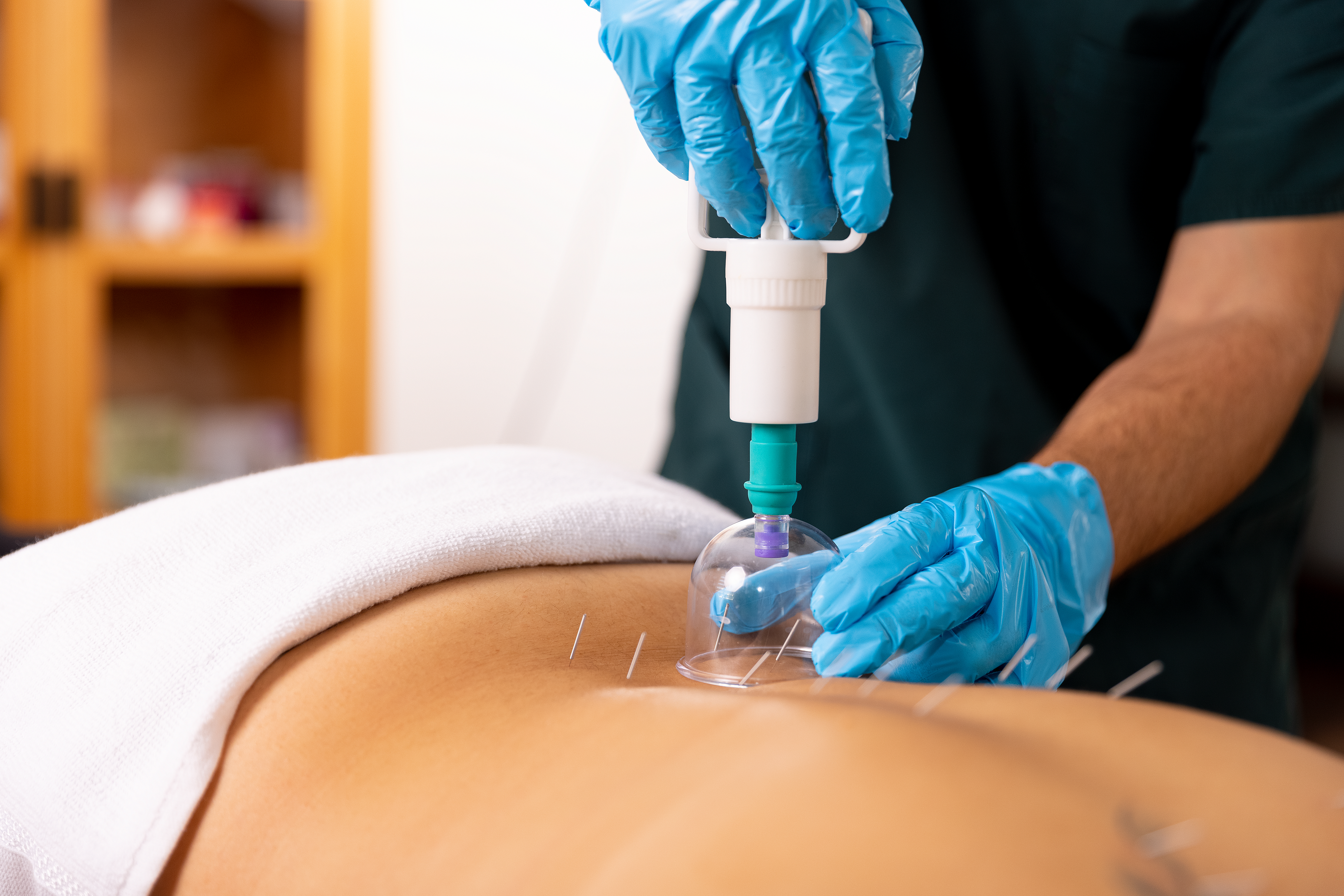 patient receiving cupping therapy on their back