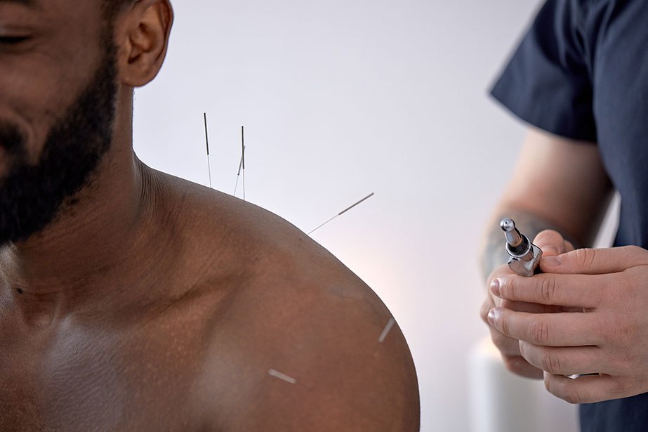 Male receiving acupuncture.