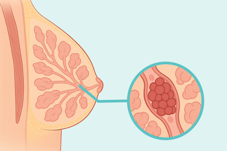 Hyperplasia