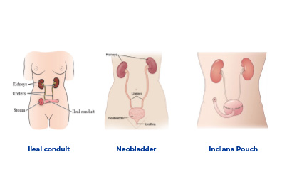 Cysectomy