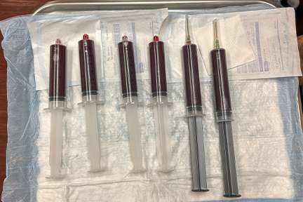 Kyrylo's blood drawn in six syringes before processing