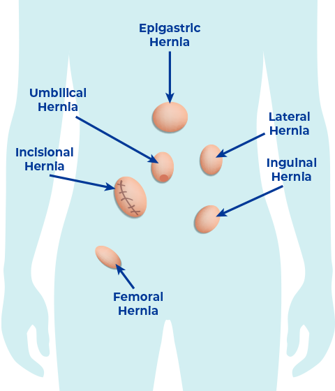 types of hernias
