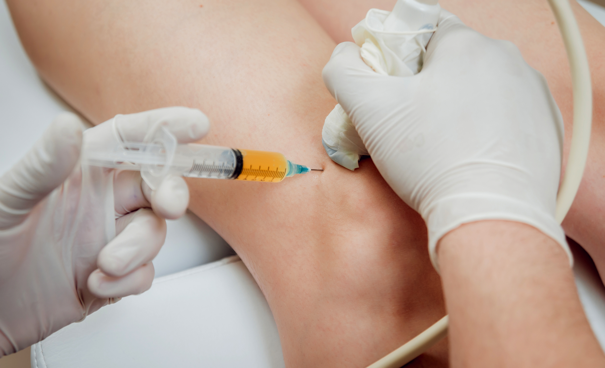 platelet-rich plasma (PRP) injection into knee with guided ultrasound